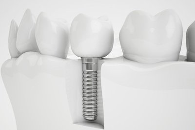 Qu son los implantes dentales?